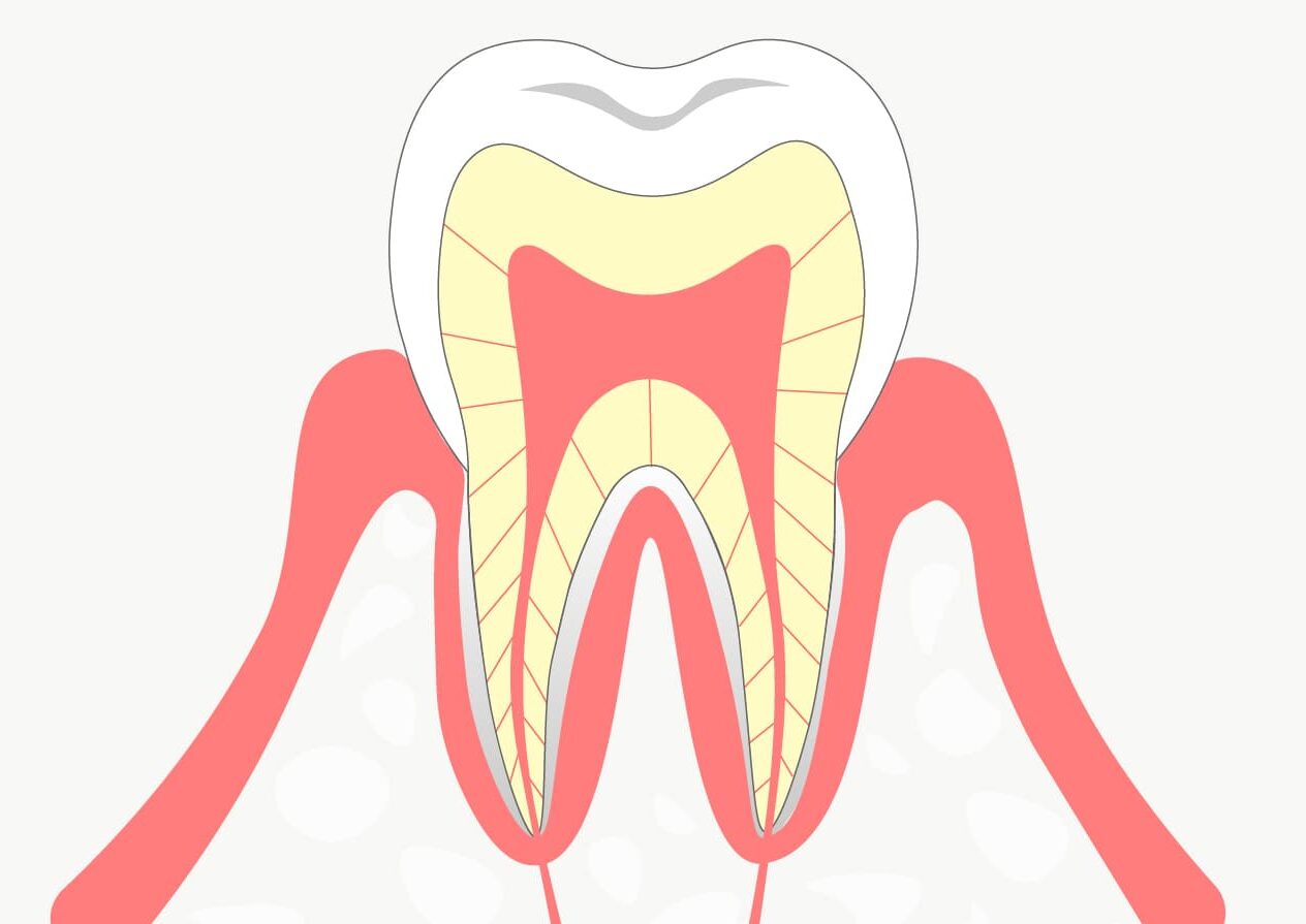 Ｃ０：初期虫歯
