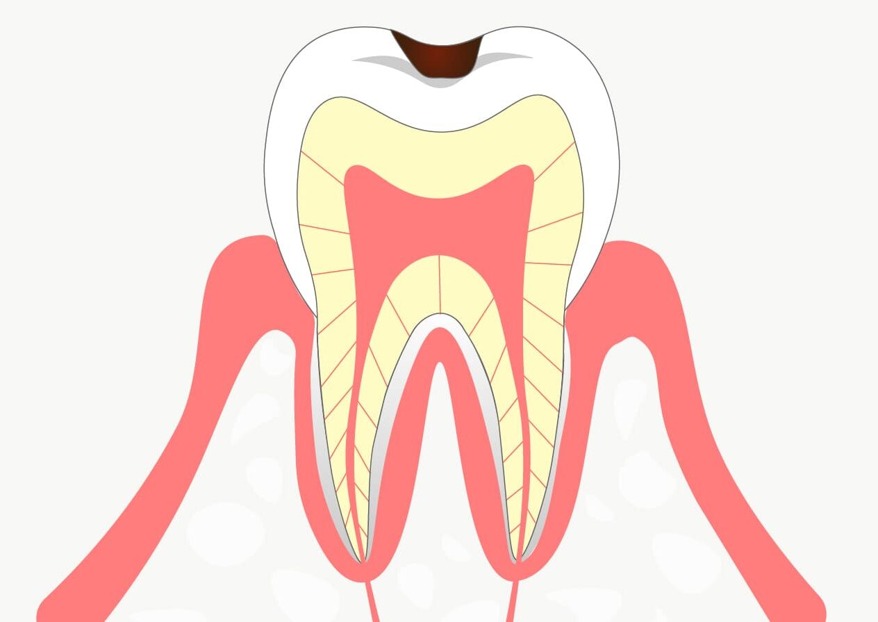 Ｃ１：エナメル質の虫歯