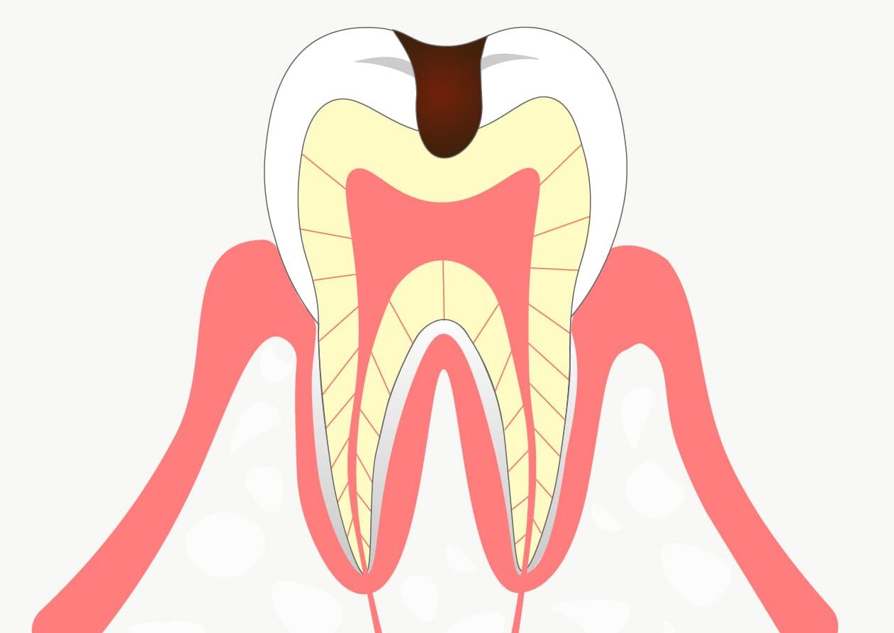Ｃ２：象牙質まで進行した虫歯