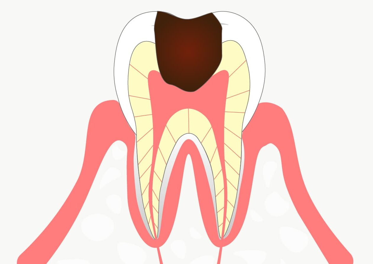 Ｃ３：神経まで到達した虫歯