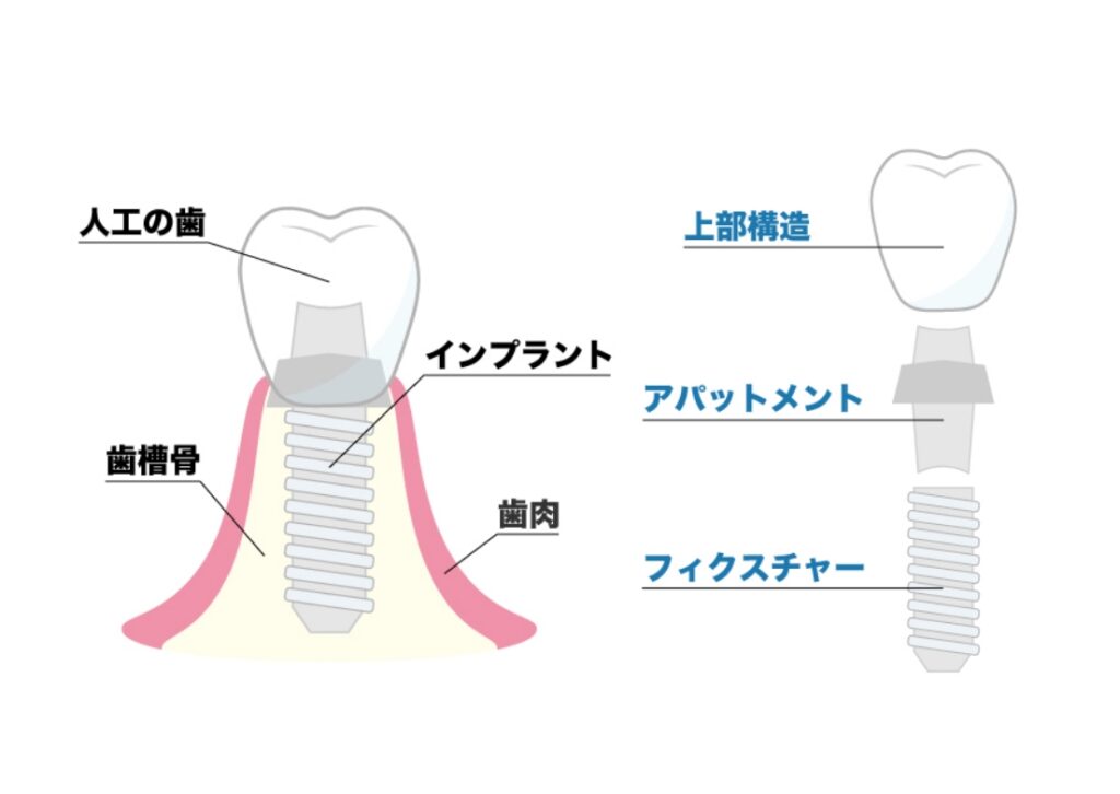 インプラントとは