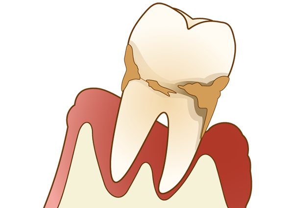 歯周病の主な原因は？