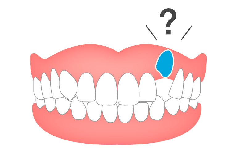 埋伏歯（埋まった歯が生えてこない）​