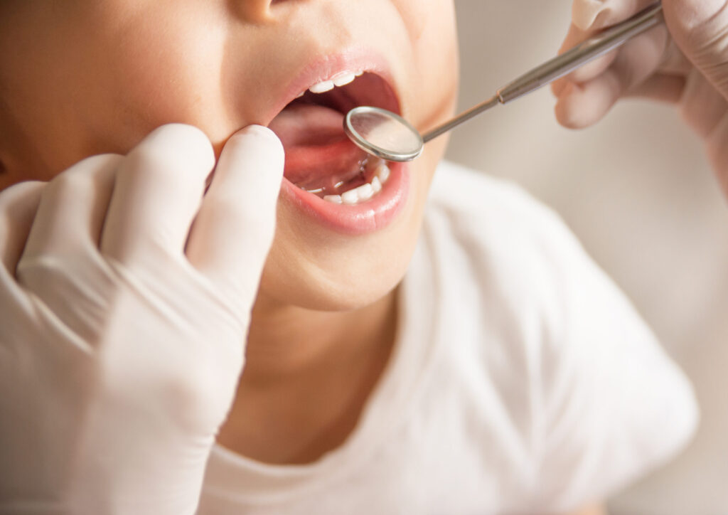 歯科医院の予防ケア