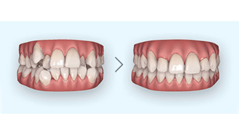 治療後の歯並びをその場で